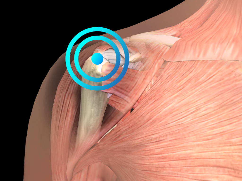 Calcifying Tendinitis Of The Shoulder EMS DolorClast