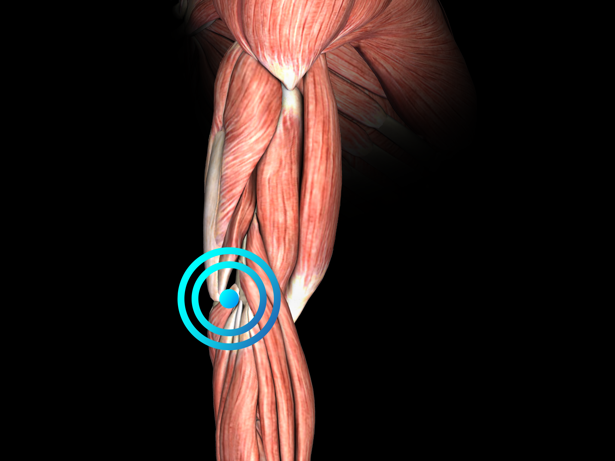 Tennis elbow lateral