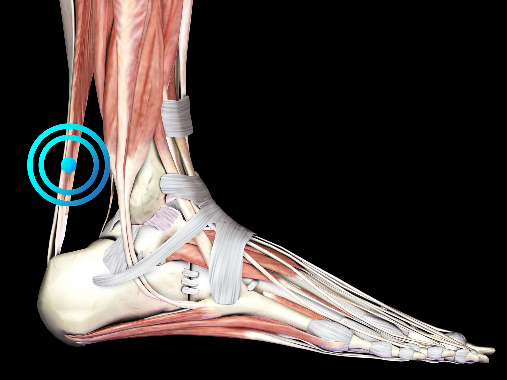 Mid-portion Achilles tendinopathy