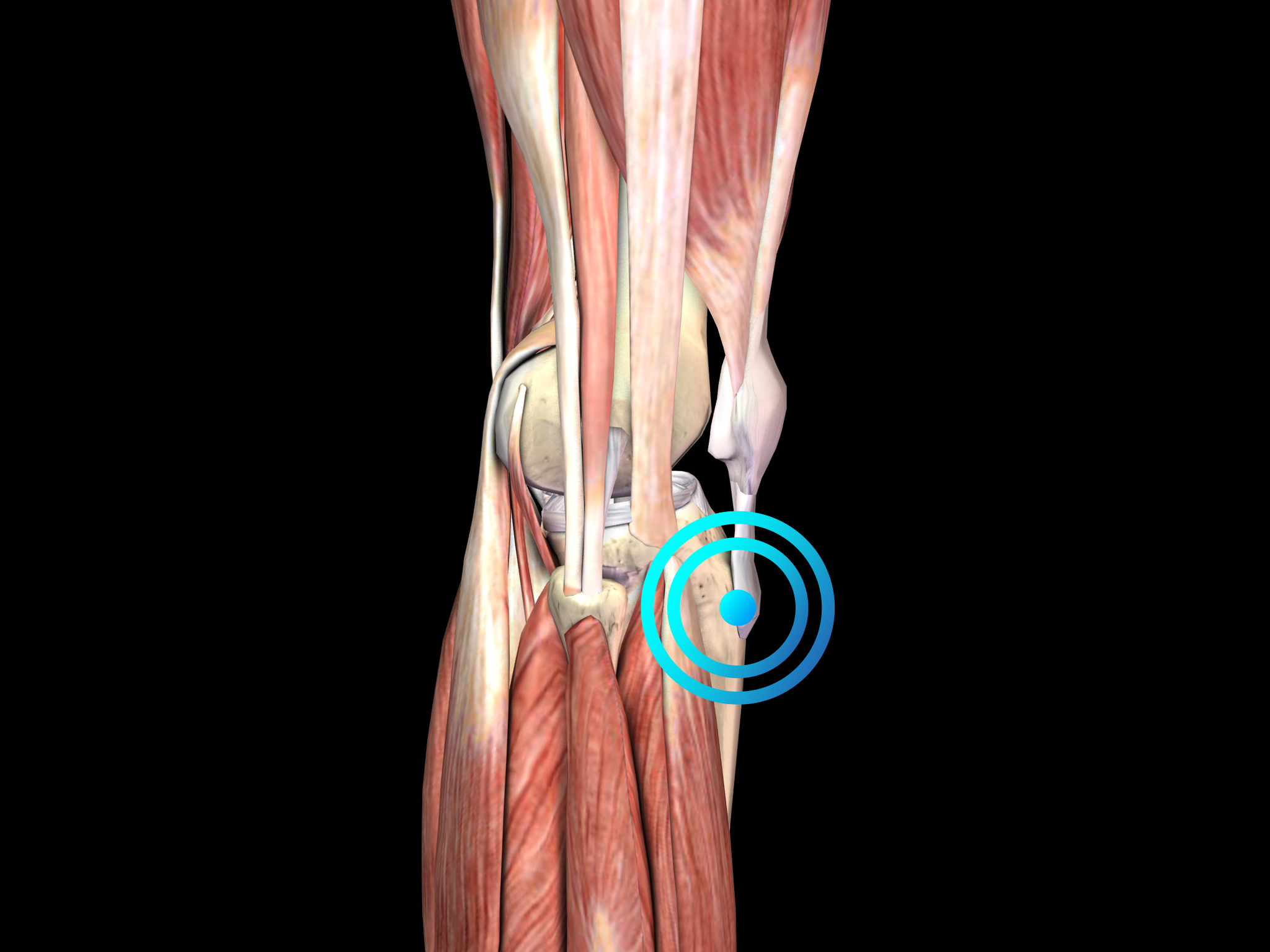 Osgood Schlatter Disease