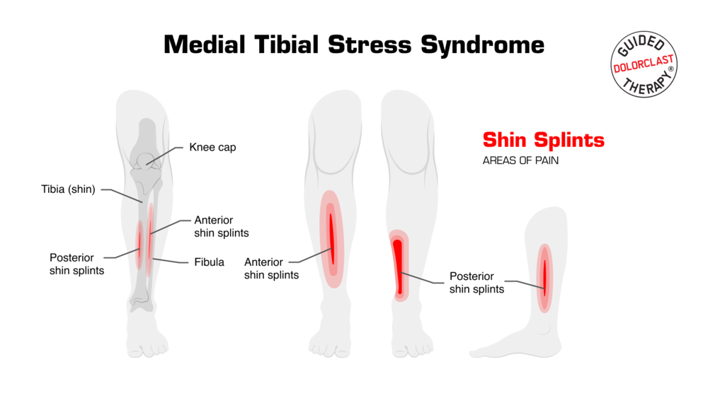 Medial tibial stress syndrome - illustration